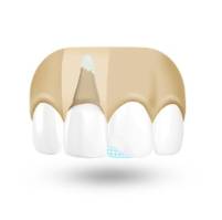 Behandlung Zahnunfall